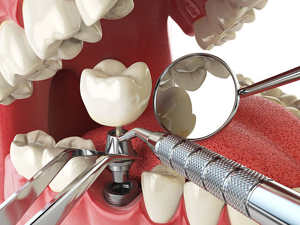 Best Knocked-Out Tooth (Avulsed Tooth) Treatment in Chester, PA
